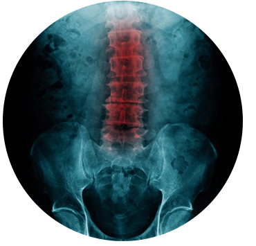 What is Sciatica Content image 2