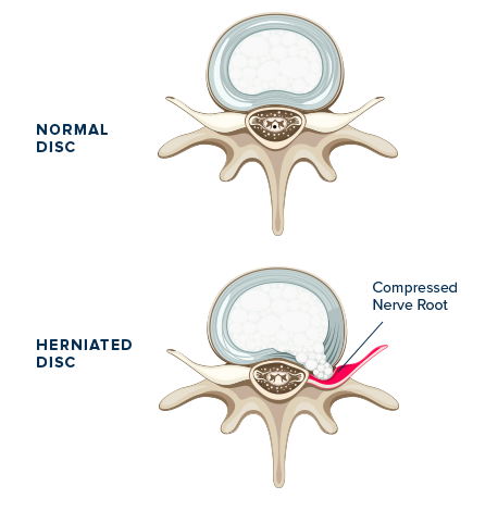 What is Sciatica Content image 1